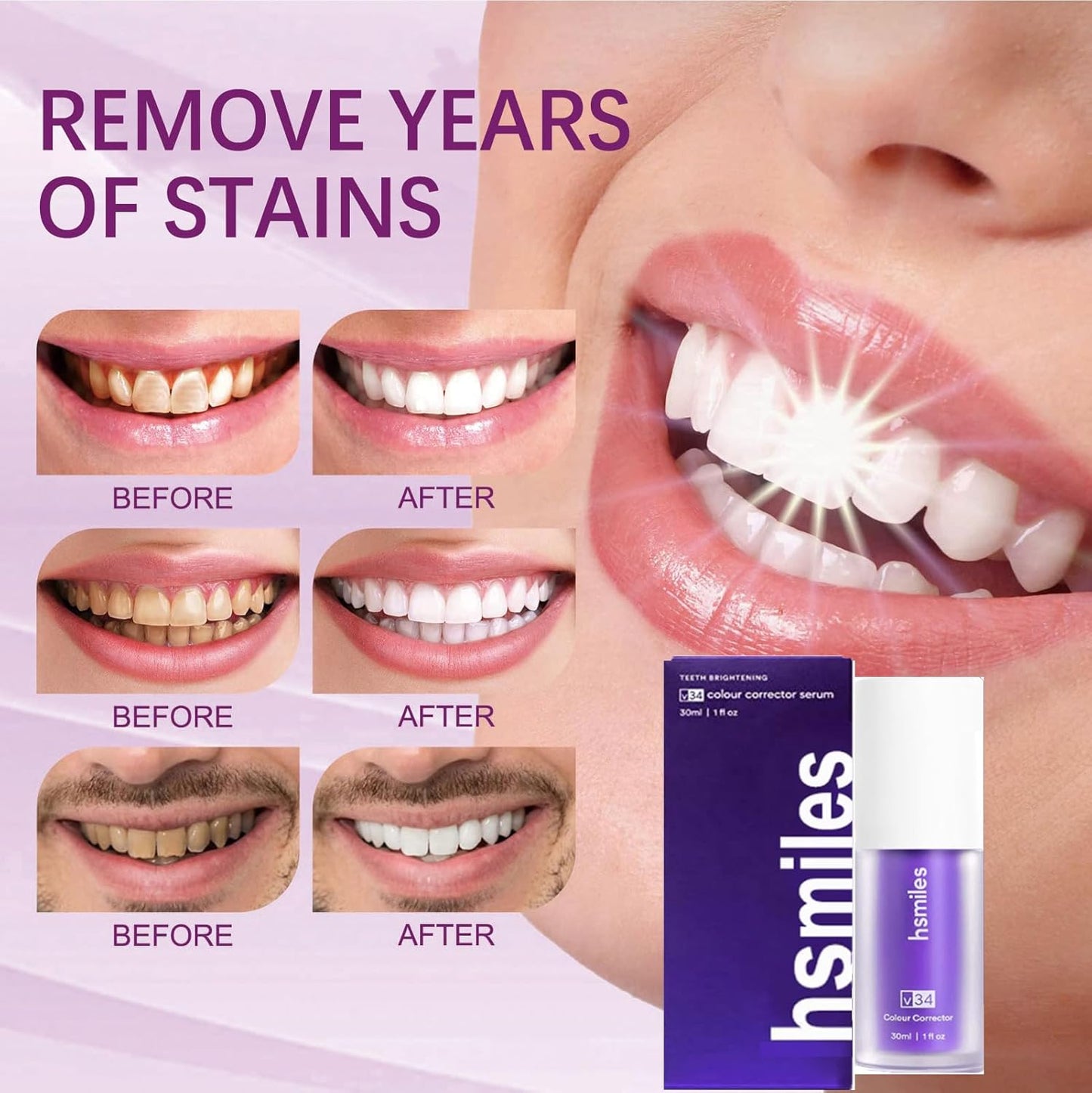 π¦·β¨ Hismile V34 Colour Corrector β Brighten Your Smile Instantly! ππ«